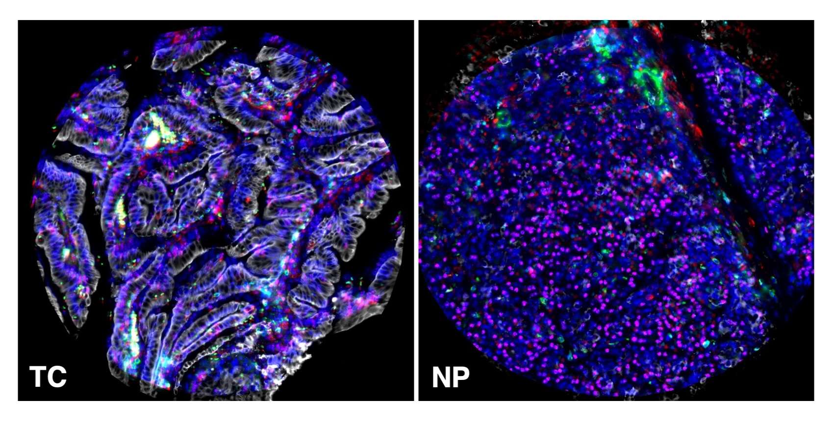 Spatial analysis of pancreatic adenocarcinoma immmunomicroenvironment