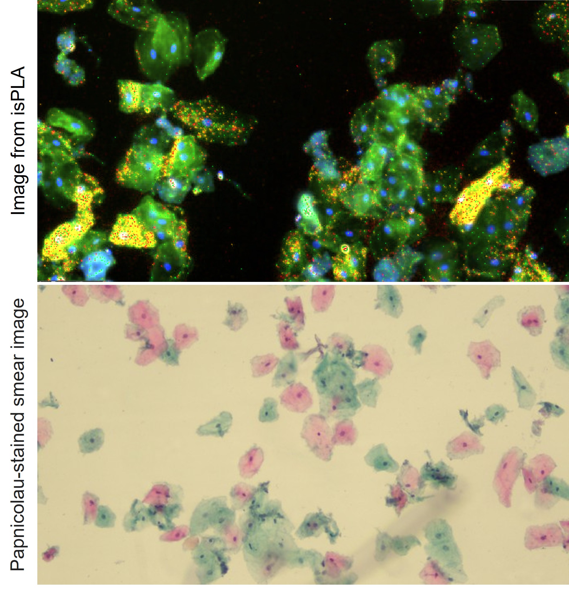 Early diagnostic of dysplastic cells from oral cavity