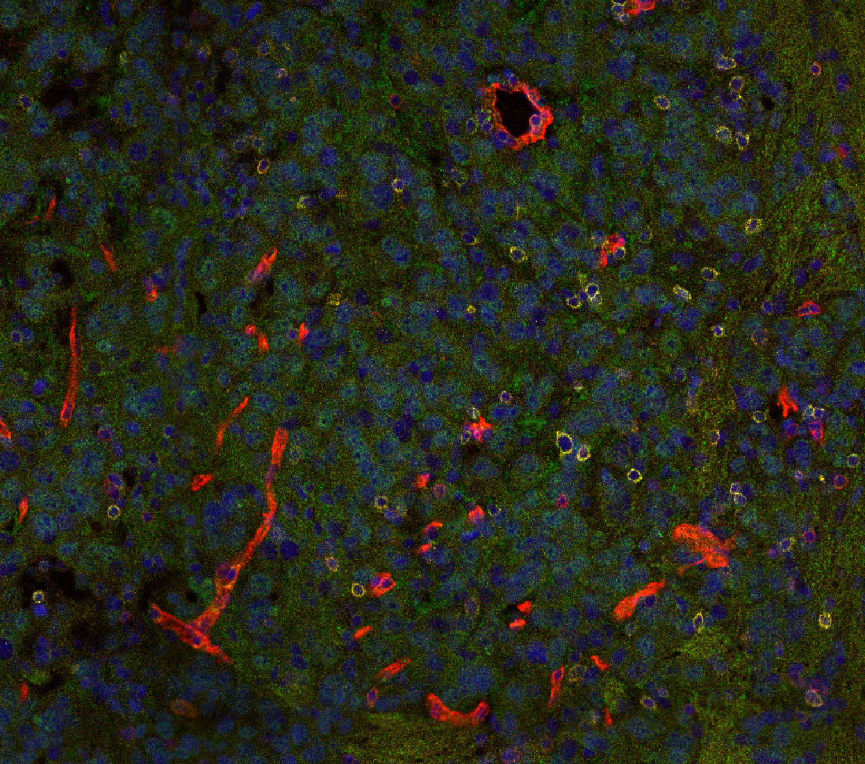 Vessel and T cell interactions in high-grade glioma